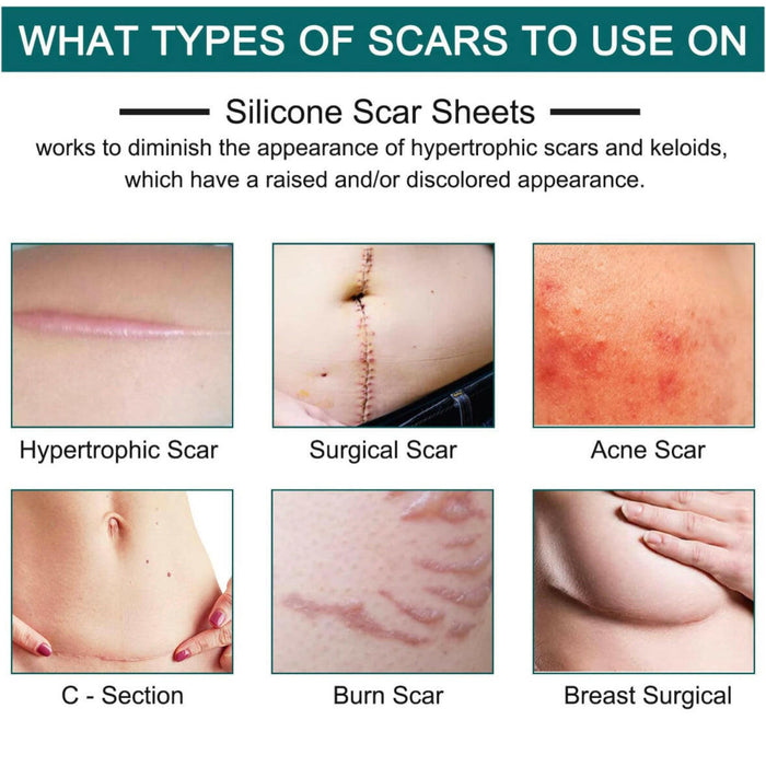 Silicone Scar Sheets (1.6” x 120” Roll-3M).